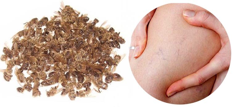 Лечение варикоза