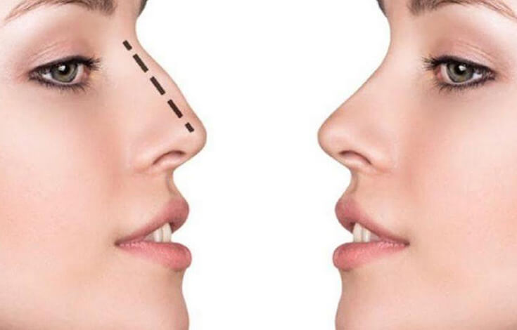 Ринопластика